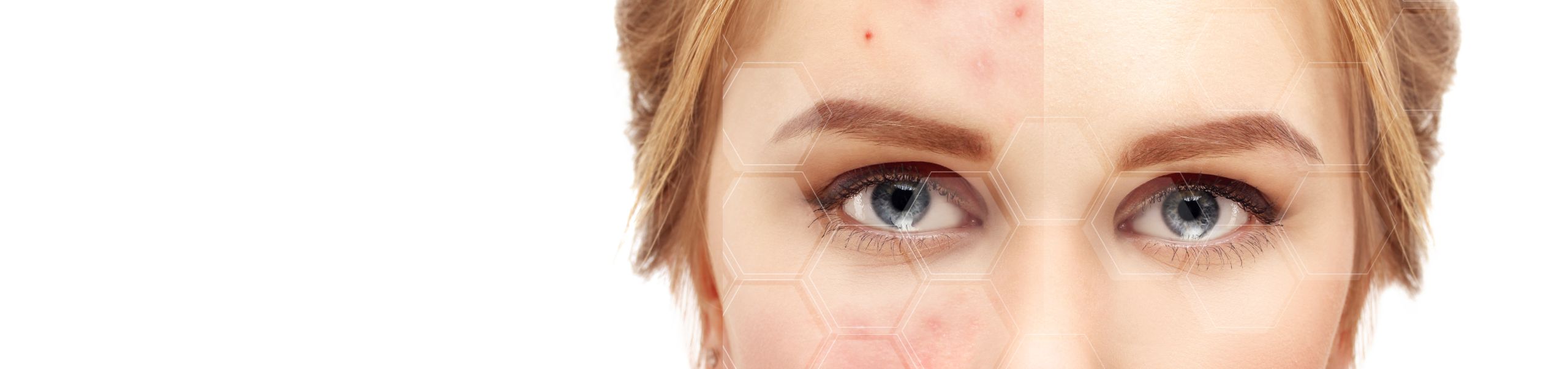 Acne & Acne Scar
